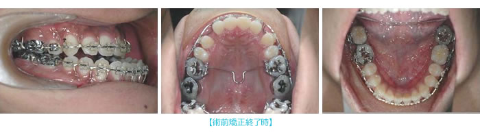 術前矯正終了時