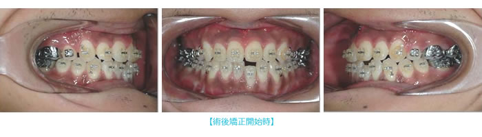 術後矯正開始時