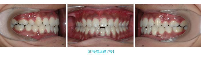 術後矯正終了時