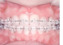 審美ブラケット