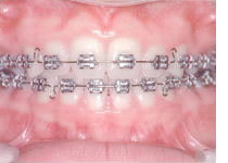 金属ブラケット