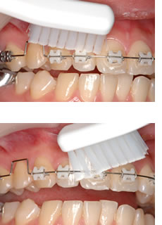 通常の歯ブラシ