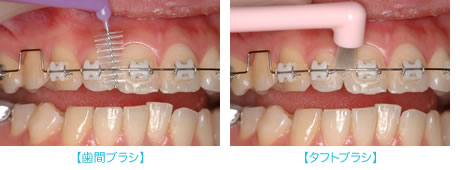 歯間ブラシとタフトブラシ
